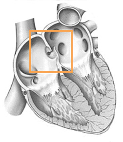 Pfo Heart